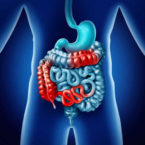 Read more about the article Doença de Crohn