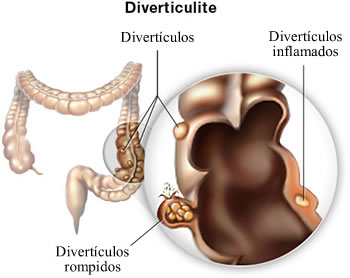 Read more about the article Diverticulite